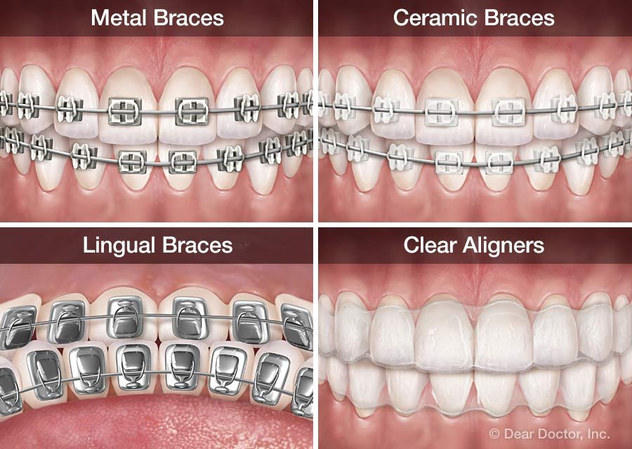Different Types Of Orthodontic Treatment - arttour.org